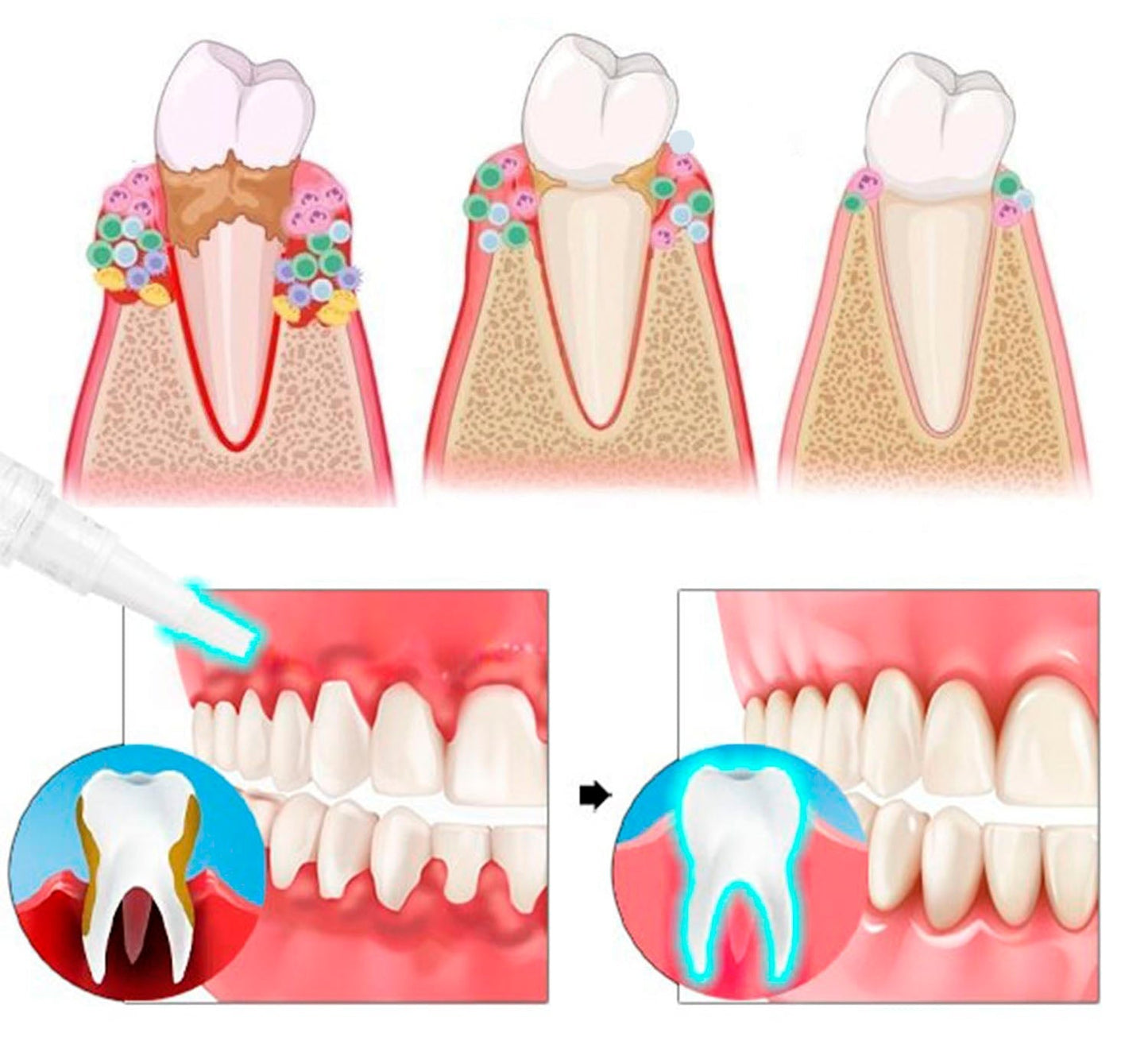 Gum Protect Gel
